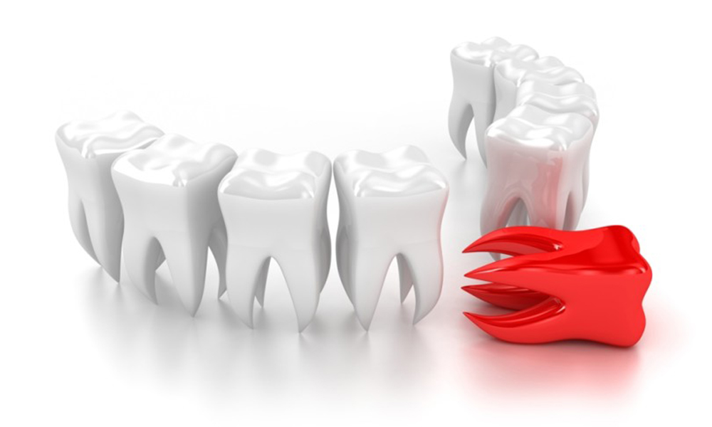 Лечение периодонтита многоканального зуба